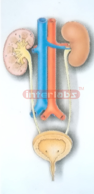 HANGING HUMAN COMMON DISEASE MODEL OF UROGENITAL SYSTEM